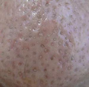 缩小毛孔淡化痘印护肤品推荐,平价祛痘缩小毛孔护肤品