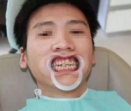 最新发布！12-80岁市民快看，种植牙、矫正牙齿10项全减免~