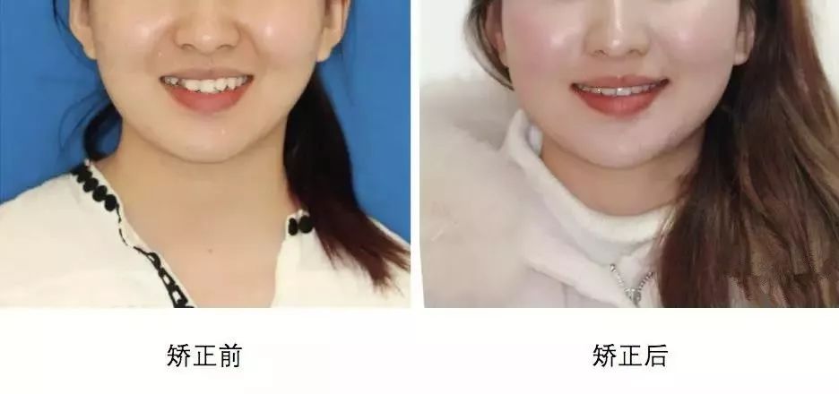 最新发布！12-80岁市民快看，种植牙、矫正牙齿10项全减免~