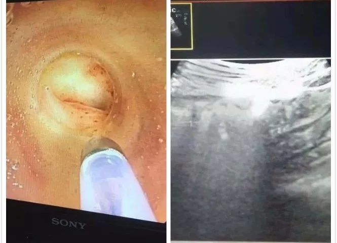 阑尾穿刺引流每天都有一点脓液,阑尾炎镜下治疗