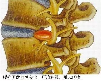 腰肌劳损如何缓解和治疗,腰肌劳损怎么自己缓解