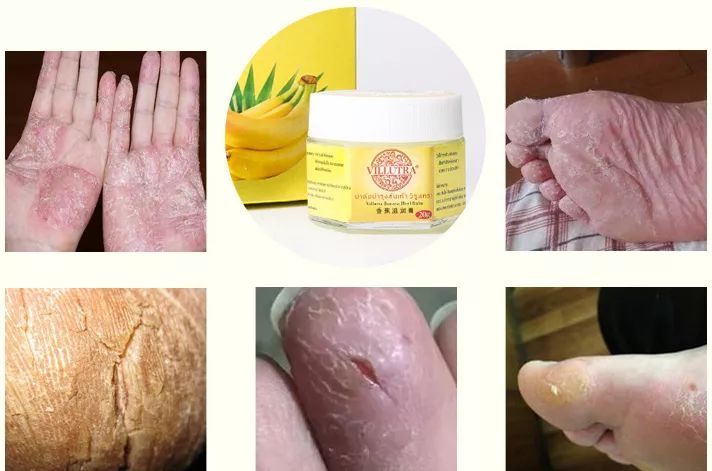 快速修复手干裂,冬季皮肤干燥脱皮面霜