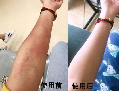 脚气湿疹止痒最快的软膏,湿疹止痒膏可以治脚气吗