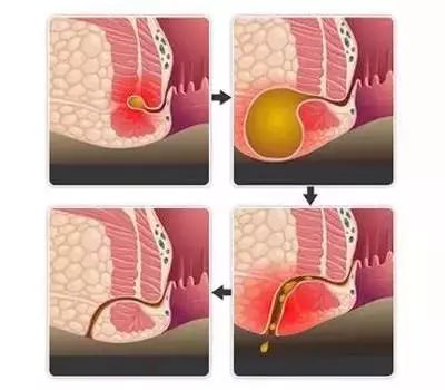 肛瘘揭秘,科普肛瘘为什么不能自愈