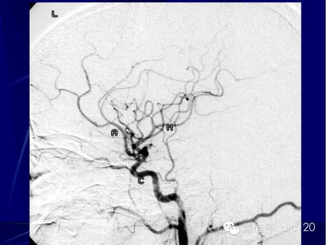 脑血管解剖技巧,脑血管解剖与介入