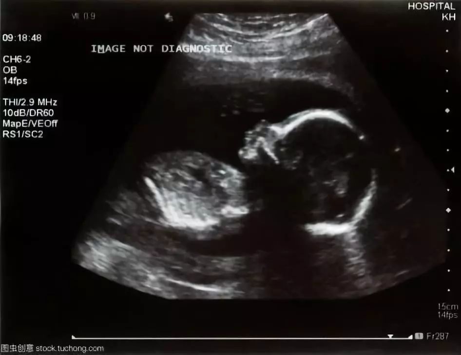 产检B超：能偷看宝宝几次？