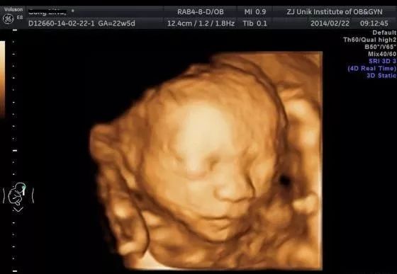 产检B超:能偷看宝宝几次?