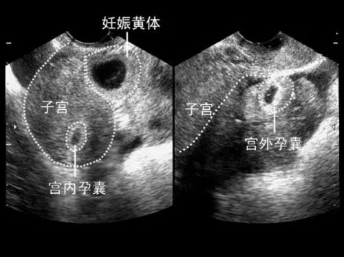 产检B超:能偷看宝宝几次?