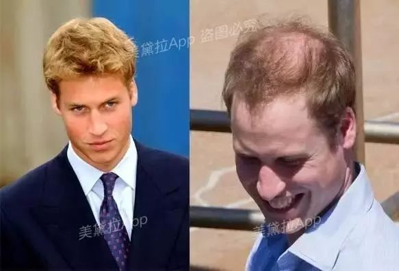 头等大事脱发青年自救指南,秃头女孩必看6大脱发误区