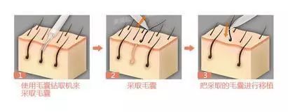 头等大事脱发青年自救指南,秃头女孩必看6大脱发误区