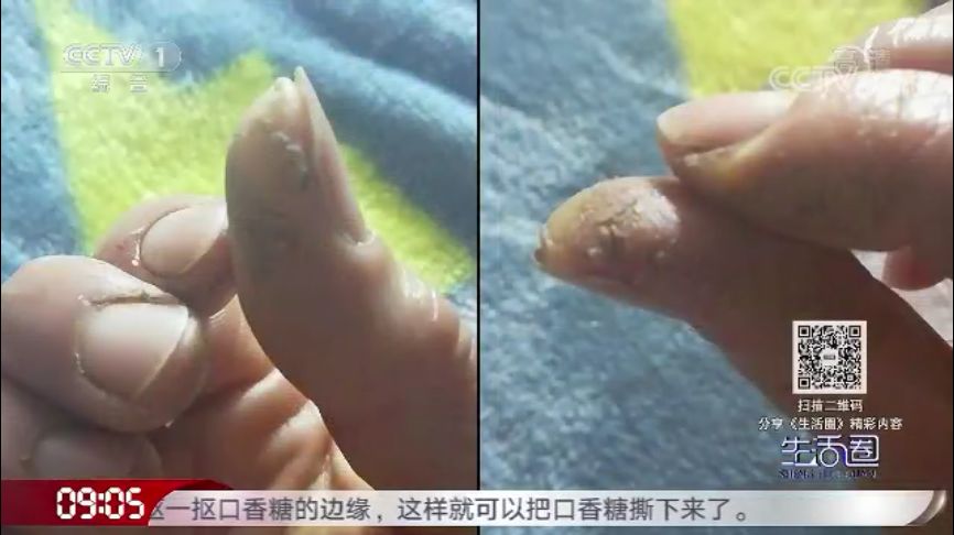 一到冬天手脚起皮干裂怎么治,冬天手脚干裂一招轻松缓解