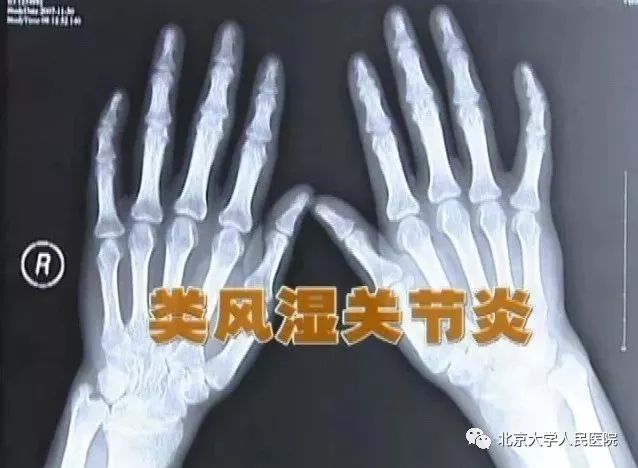 预告｜类风湿关节炎，预防控制至关重要！北京大学人民医院栗占国做客BTV《健康北京》