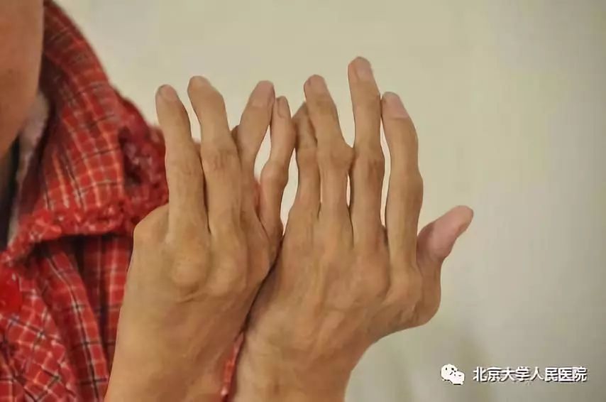 预告|类风湿关节炎,预防控制至关重要!北京大学人民医院栗占国做客BTV《健康北京》