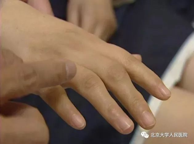 预告｜类风湿关节炎，预防控制至关重要！北京大学人民医院栗占国做客BTV《健康北京》