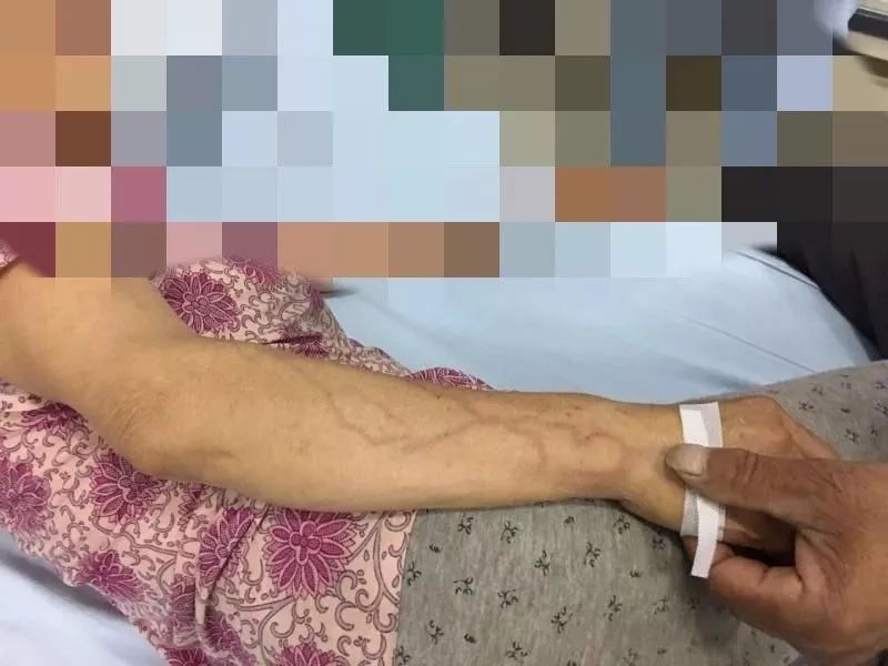 输液之后手臂上出现红点,输液时手臂出现红色纹路