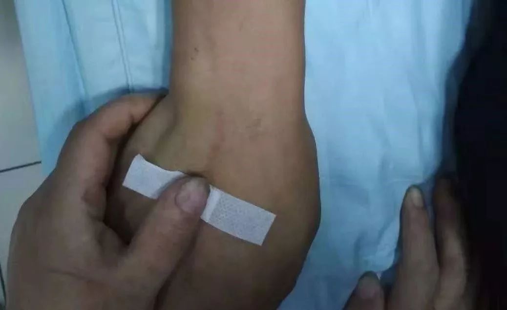 输液之后手臂上出现红点,输液时手臂出现红色纹路