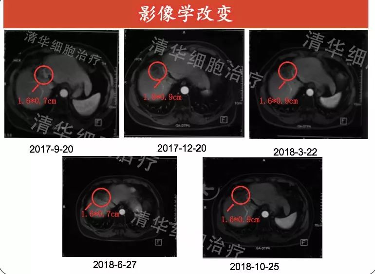 「肝胆管细胞癌，NKT治疗案例展示」清华NKT·乐和亲友2016-43