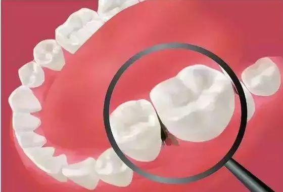 吃东西塞牙而且牙缝还特别臭,吃东西牙缝老塞牙怎么办