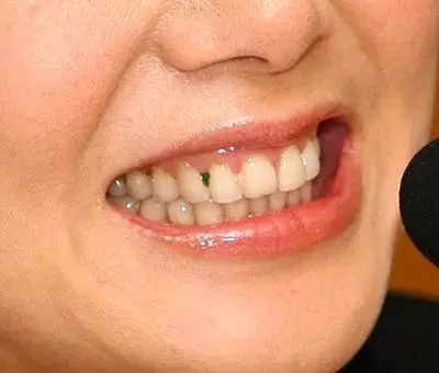 吃东西塞牙而且牙缝还特别臭,吃东西牙缝老塞牙怎么办