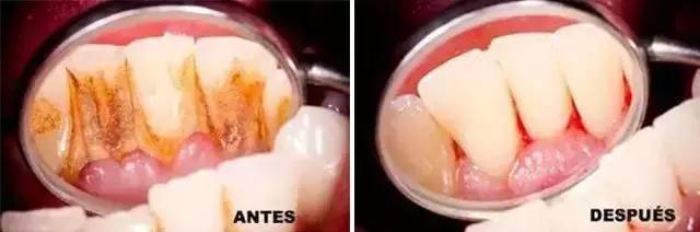 吃东西塞牙而且牙缝还特别臭,吃东西牙缝老塞牙怎么办