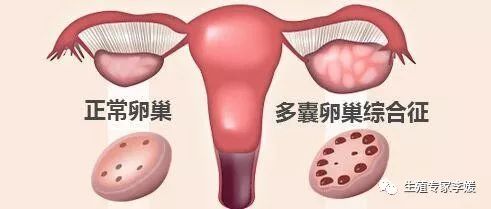 多囊卵巢综合征会影响胚胎发育吗,多囊卵巢综合症会影响胚胎发育吗