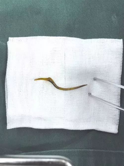 吃烧烤喉咙被竹签刺了一下怎么办,吃完火锅嗓子痛26岁姑娘遭遇夺命