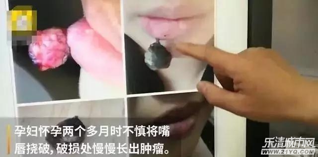孕妇嘴唇出泡了还痒怎么办,孕妇嘴唇长单纯疱疹咬破了