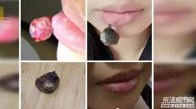 孕妇嘴唇出泡了还痒怎么办,孕妇嘴唇长单纯疱疹咬破了