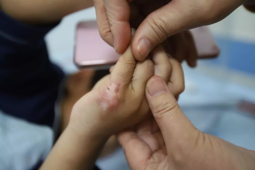 心疼小孩被烫伤,心疼孩子被烫
