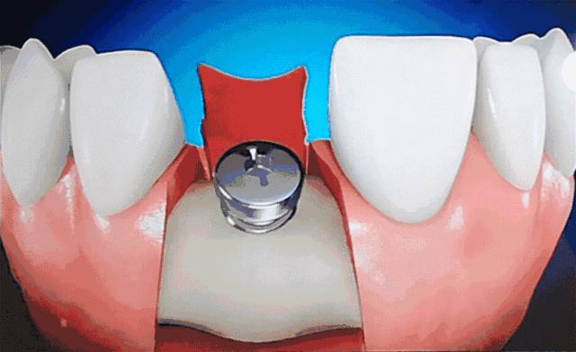 推广|身份证42开头的注意!牙齿矫正、种植牙,这些全免费!