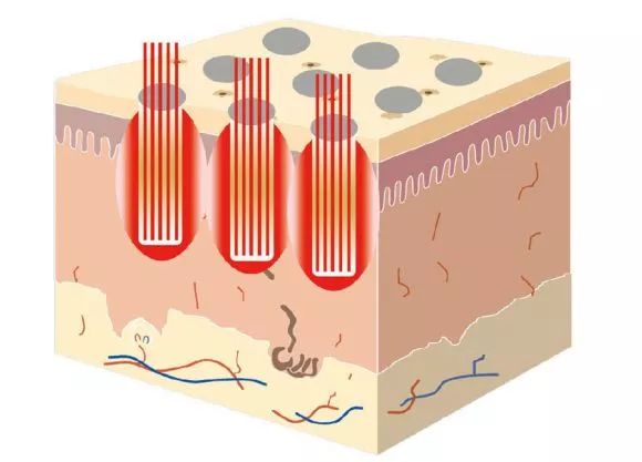 额头闭口留下痘印怎么解决,痘印泛红怎么解决