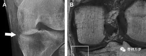 肩关节脱位易漏诊的骨折,放射科容易漏诊的骨折