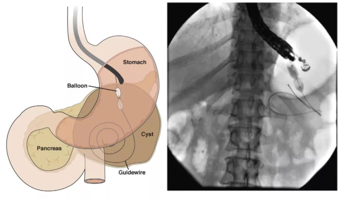 权威研究说，胰腺液体积聚引流，内镜可以这样用