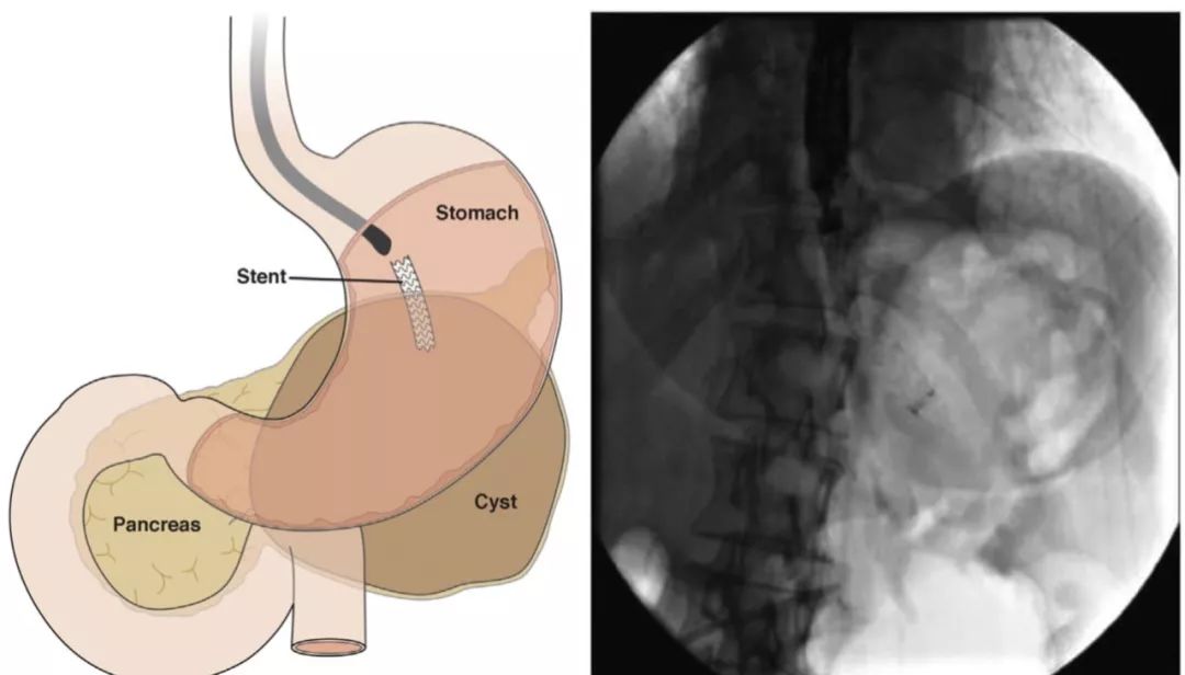 权威研究说，胰腺液体积聚引流，内镜可以这样用
