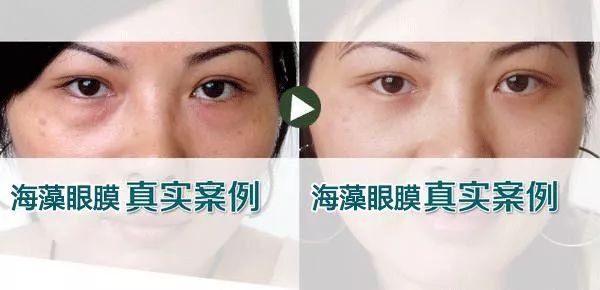 50岁没有眼袋眼纹黑眼圈,60岁去眼袋的最佳方法