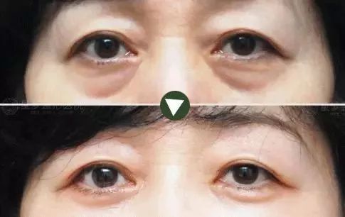 50岁没有眼袋眼纹黑眼圈,60岁去眼袋的最佳方法