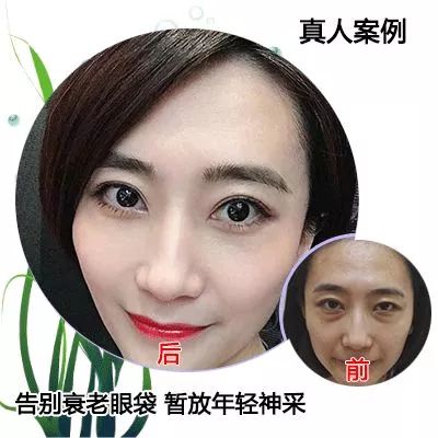 50岁没有眼袋眼纹黑眼圈,60岁去眼袋的最佳方法