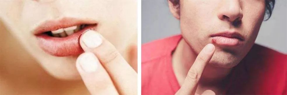 唇膜贴干唇救星,唇干裂用什么护唇