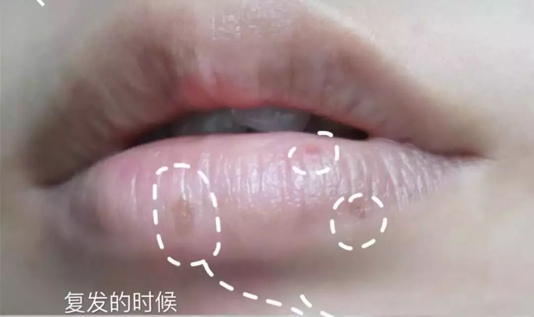 唇膜贴干唇救星,唇干裂用什么护唇