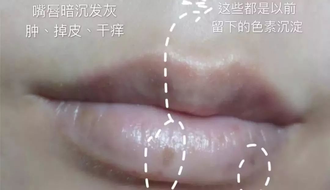 唇膜贴干唇救星,唇干裂用什么护唇