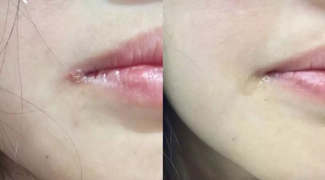 唇膜贴干唇救星,唇干裂用什么护唇