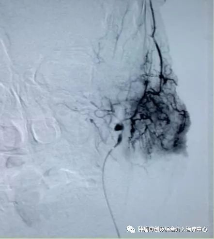 运城第一医院肿瘤介入科专家,运城市第一医院介入科专家
