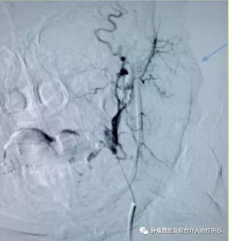 运城第一医院肿瘤介入科专家,运城市第一医院介入科专家