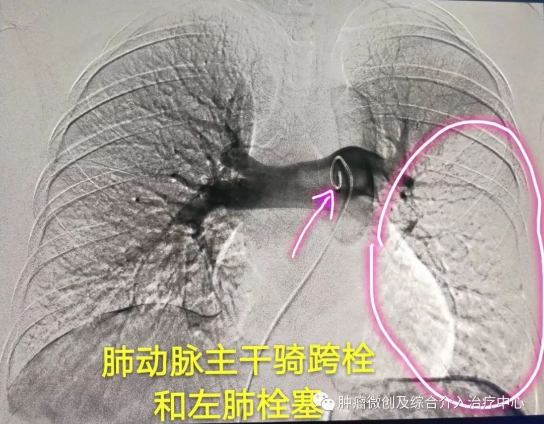 运城第一医院肿瘤介入科专家,运城市第一医院介入科专家