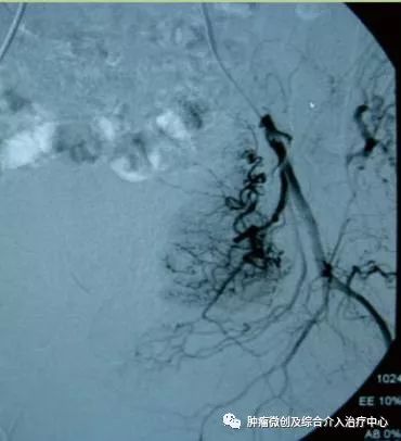 运城第一医院肿瘤介入科专家,运城市第一医院介入科专家