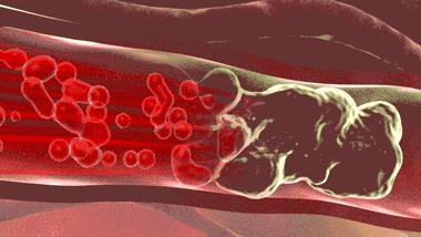 血脂异常是无声的杀手,血脂异常医生健康科普