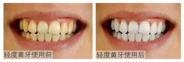 韩国钻石美白牙齿的牙膏好用吗,韩国牙膏排名第一名儿童