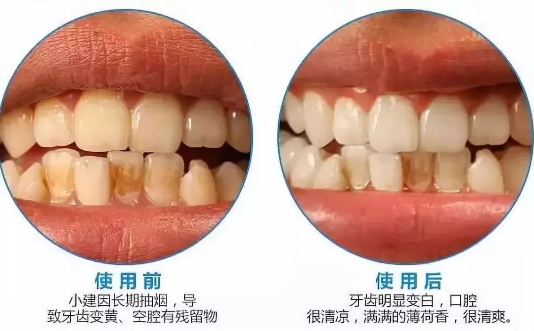 韩国钻石美白牙齿的牙膏好用吗,韩国牙膏排名第一名儿童