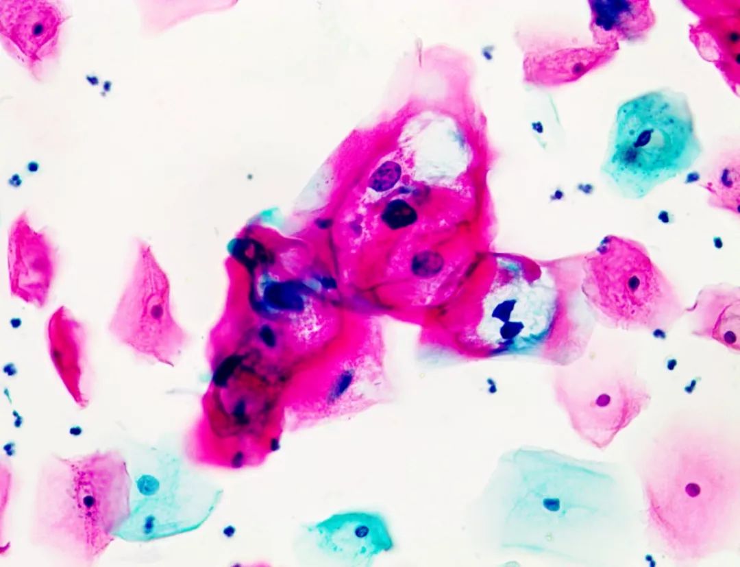 tct和hpv检查哪个确诊宫颈癌,宫颈癌筛查检查dna还是tct