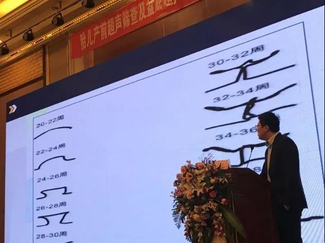 胎儿产前超声筛查,超声产前筛查汇报